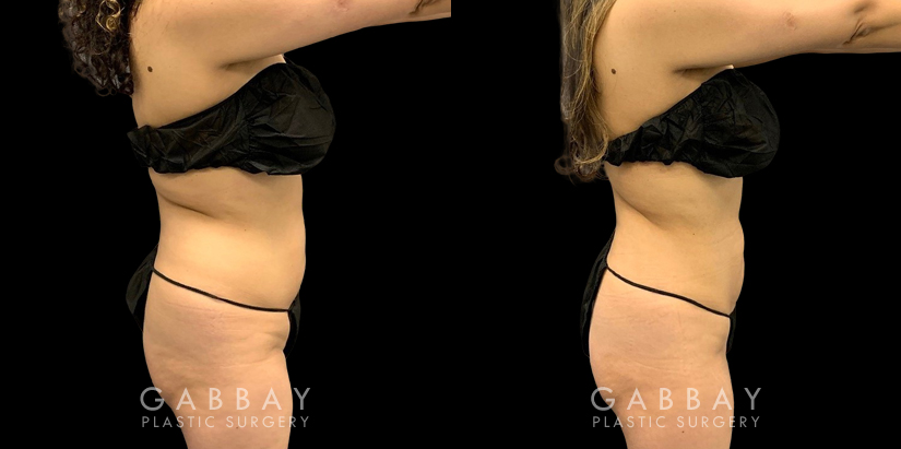 Patient with mild liposuction for the abdomen to help reduce some of the stubborn pockets of fat while also slimming the waist for a renewed youthful shape.