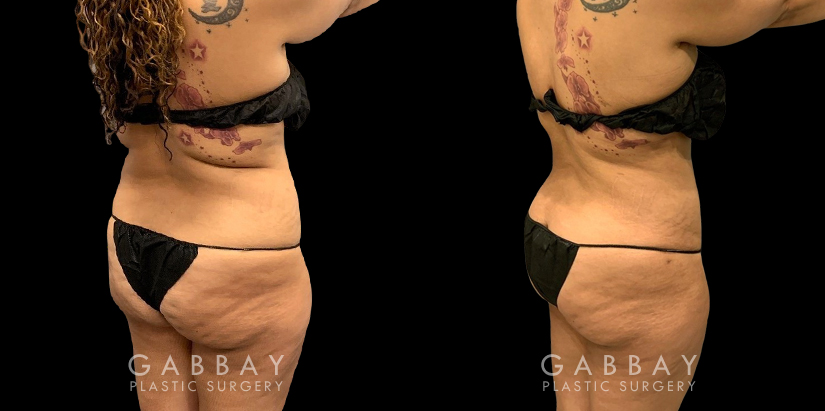 Patient who wanted to address a more significant amount of fat over the belly area. Using targeted liposuction, Dr. Gabbay removed the fat while keeping a balanced shape and aesthetic to the abdominal area.