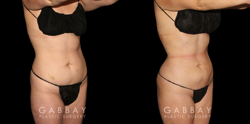 Patient 46 3/4th Right Side View Mastopexy and Liposuction Gabbay Plastic Surgery