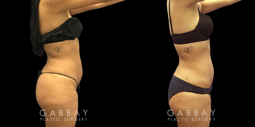 Female patient after liposuction to remove stubborn fat around the stomach and tailbone areas. Patient reported a comfortable and smooth recovery with no complications.