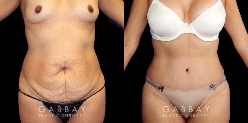Patient before and after plastic surgery combination procedure involving breast augmentation (silicone implants), tummy tuck, and liposuction of the flanks. The combined results show a slimmer, more youthful profile with an enhanced feminine shape.