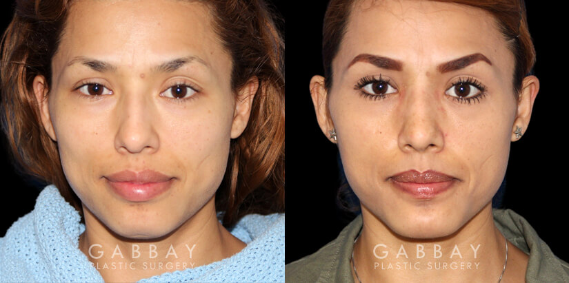 Patient 01 Front View Chin implant, Rhinoplasty, BAM Gabbay Plastic Surgery