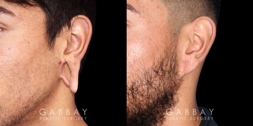 Patient 01 3/4th Left Side View Earlobe Repair Gabbay Plastic Surgery