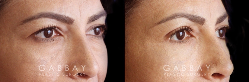 Patient 01 3/4th Right Side View Blepharoplasty Gabbay Plastic Surgery