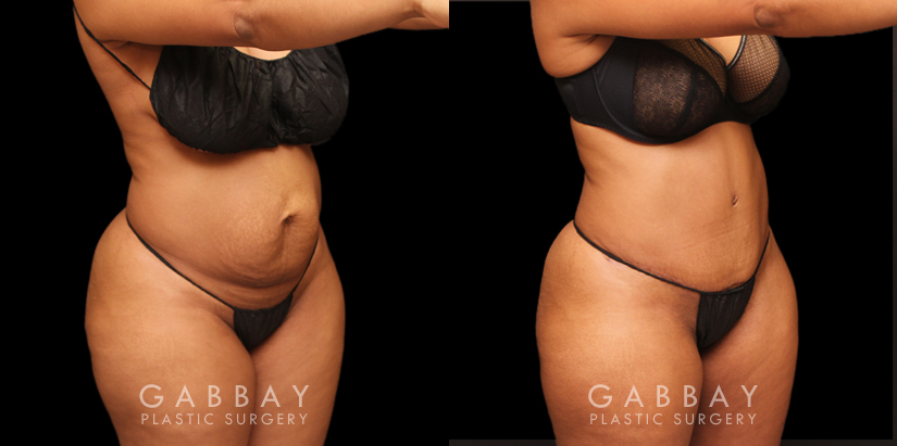Tummy tuck patient before and after her procedure. Photos demonstrate the lack of visible scarring, a flattened abdomen, and removal of stretch marks through precise tightening techniques.