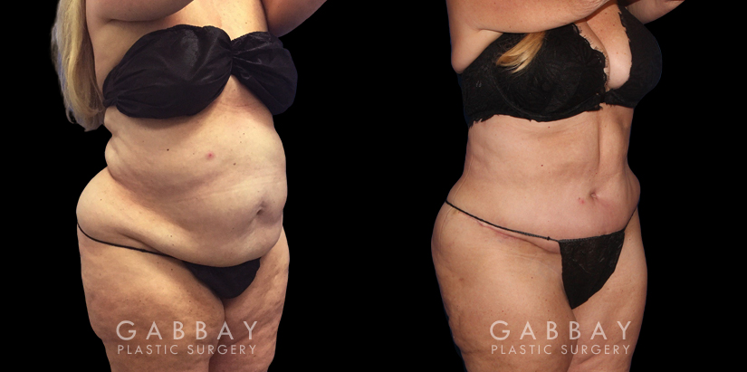 Tummy tuck patient results after abdominal tightening and liposuction to remove loose skin and stubborn pockets of fat. Note the complete tightening of back rolls, resulting in a smoother profile.