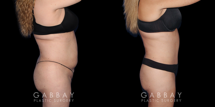 Photos of patient results after a combination of multiple liposuction procedures, each targeting a different area. Liposuction of the back bra roll, arms, and Buffalo hump augmented by abdominal tightening produced a flat, tighter torso from each angle.