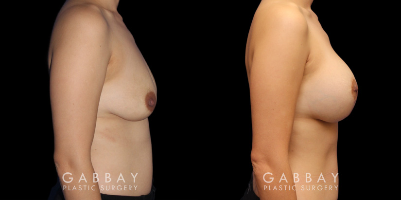 Scar revision to breasts results with additional breast augmentation and lift combination. Patient improved breast size and position with mild scarring only.