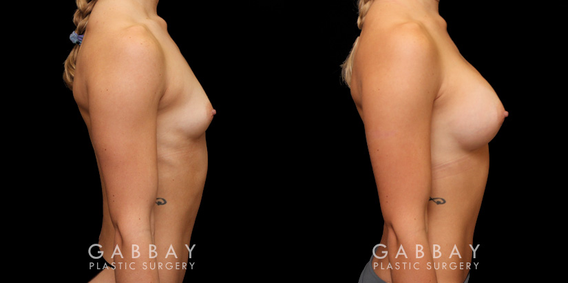 Patient 12 Right Side View Breast Augmentation Silicone Implants Gabbay Plastic Surgery