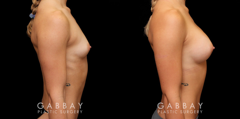 Patient before and after breast augmentation with silicone implants for both breasts. Patient’s naturally slender body type balanced well with smaller implants.