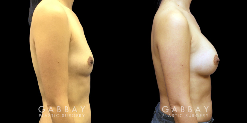 Breast augmentation results for patient in her 40s. Volume increase is mild but retains a natural shape to the breasts with retained symmetry.