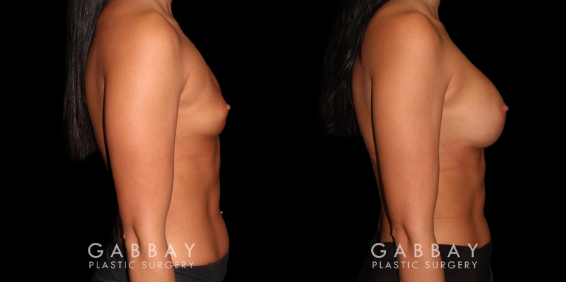 Patient results for breast augmentation. Note the rounded shape and lack of visible scarring. Patient’s recovery was smooth, absent of complications.