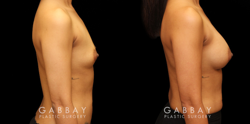 Patient 15 Right Side View Breast Augmentation Silicone Implants Gabbay Plastic Surgery