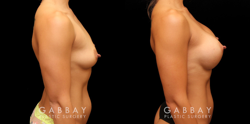 Patient photos showing before and after her breast augmentation procedure, with notable breast size increase while maintaining a balanced aesthetic.