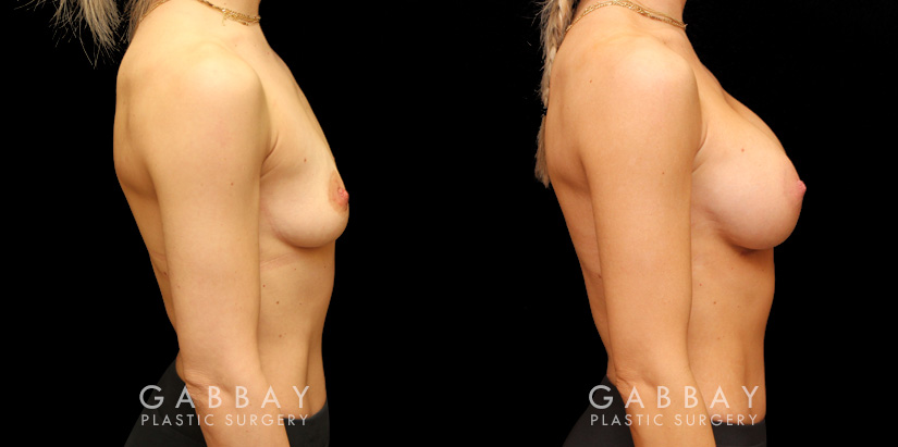 Silicone breast augmentation results after full recovery. Multi-angle view shows the boost to volume from each side for an alluring profile.