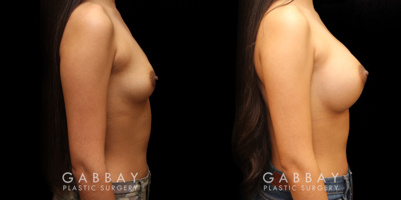 Breast augmentation for younger female patient. Note the pleasing roundness to the breasts that matches her natural body shape well for an attractive enhancement.