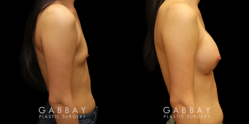 Patient results from breast augmentation, showing the increase from minimal breast size to a round, fuller appearance that suits her body shape.