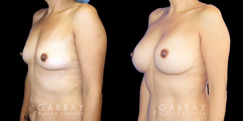 Breast augmentation results including silicone implant augmentation combined with tummy tuck and flank liposuction. The final result is a tightened body contour with enhanced breast size.