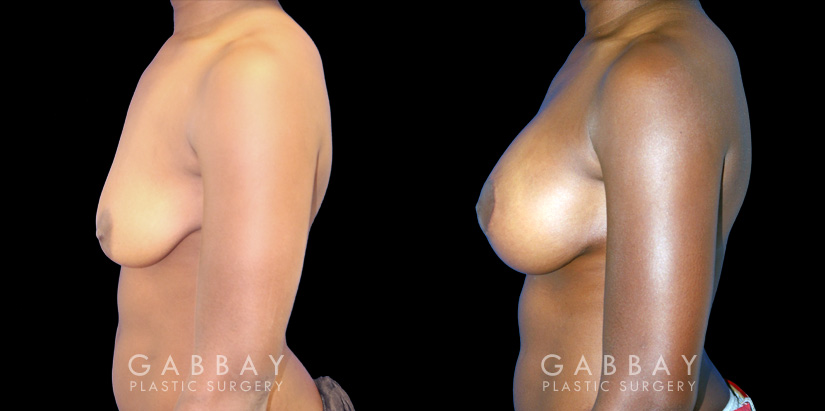 Silicone breast augmentation before-and-after photos demonstration enhanced breast size. Patient combined augmentation with a breast lift for improved breast position as well.