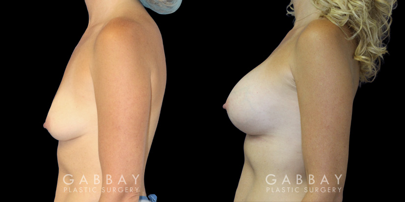 Patient in her mid 40s following breast augmentation. Before-and-after photos show her fully healed results from each angle, demonstrating the improved breast volume.