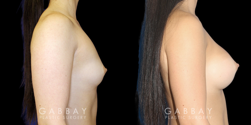 Patient with silicone implants, photos demonstrating final breast size after complete and uncomplicated recovery period. Note the improved profile and side angles, with no visible scarring.