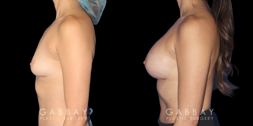 Breast augmentation before-and-after photos for female patient. Final results healed well, matching her body shape and contour well.