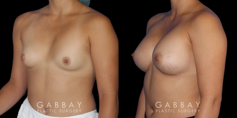 Photos showing patient following complete recovery from breast augmentation with silicone implants. Breast volume increased from minimal size to full, refined volume.