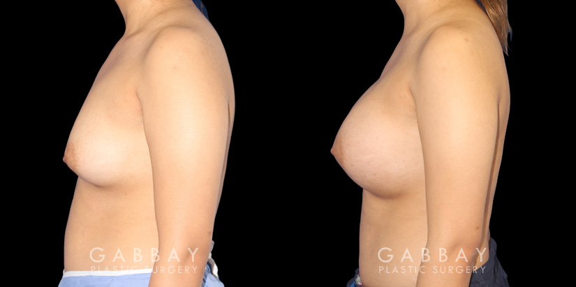 Silicone breast augmentation results, with patient having notable increase in breast volume and protrusion. But the breasts still maintain a balance between them.