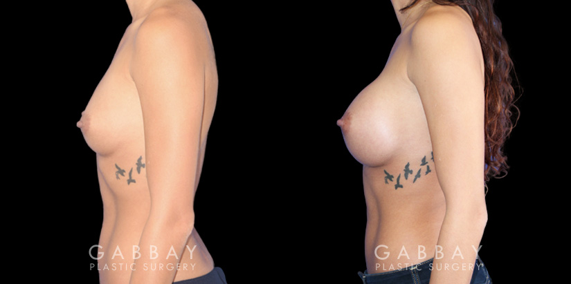 Breast augmentation patient with final results Note the significant increase in breast volume while keeping the shape within natural bounds. Note the absence of visible scarring which is rare with such increases in breast volume.