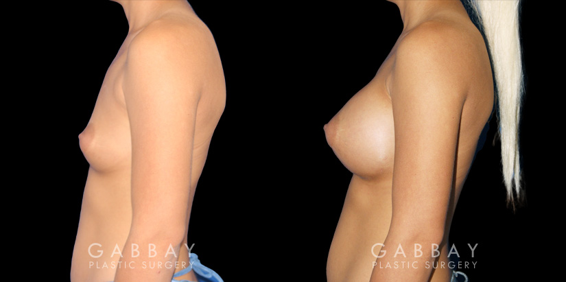 Before-and-after photos for breast augmentation with saline implants. The choice of saline implants allowed for more dramatic increase in breast size while having no visible scars.