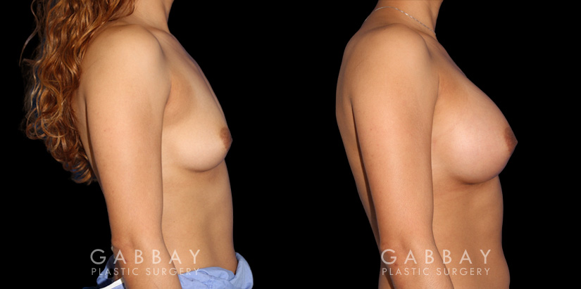 Silicone implant results for female patient in her 30s. Mild increase to volume allowed for balanced results that match her natural body contours.
