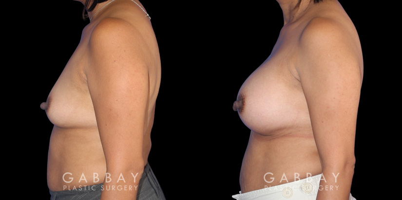 Patient before and after silicone implants with complete, uncomplicated recovery. Volume increase is notable while also improving the balance between breasts without resorting to unnatural perfect symmetry.