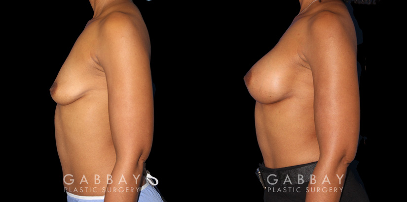 Before-and-after photos for saline implant breast augmentation patient. Her implant choice allowed for more natural shape and slope to the breasts, most notable in the profile view.