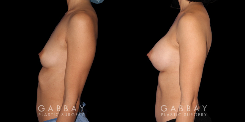 Patient result photos following silicone implant breast augmentation. Patient elected for a rounder shape with mild breast protrusion for subtle yet alluring results.