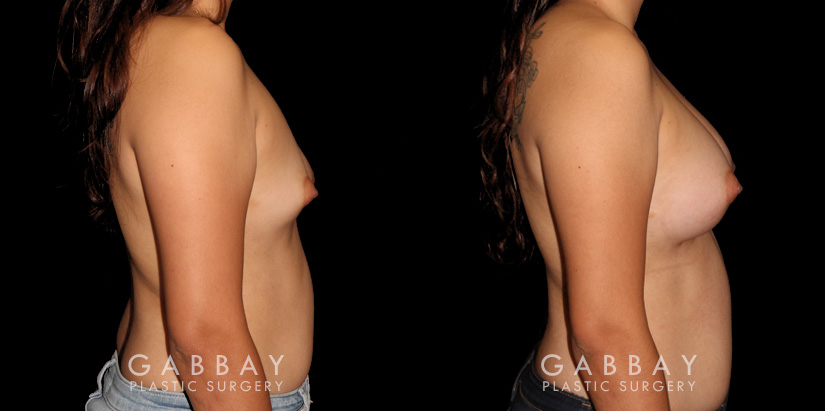 Before-and-after photos for patient with unilateral breast lift and bilateral breast augmentation. The improved symmetry restored a more natural look to the breasts with even nipple position.