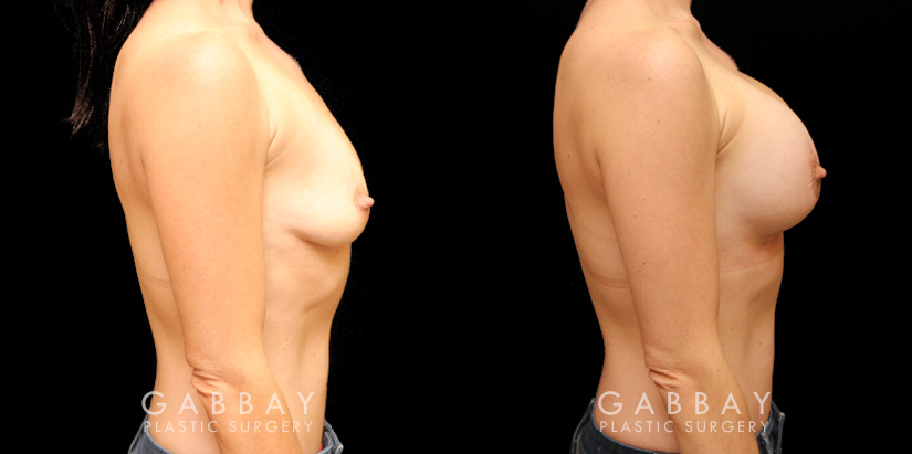 Patient with combined areola lift and breast augmentation, photos showing her before and after the procedure. Not the improved breast position and increased volume.