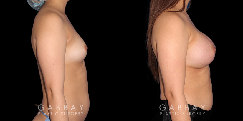 Silicone breast implants after full recovery. Patient increased breasts by several cup sizes without stretching out the skin, maintaining a round alluring shape with boosted volume.