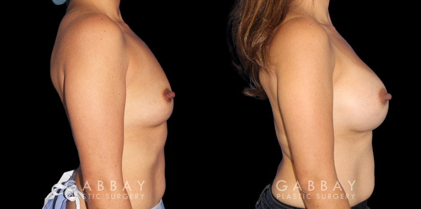 Silicone implants used to increase breast volume while keeping a natural shape. Patient healed well with no complications.