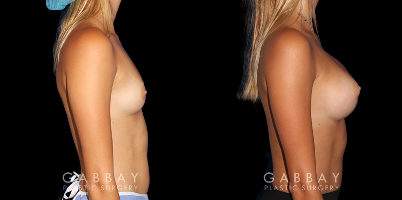 Patient results following complete recovery from breast augmentation procedure. Patient achieved increased bust size with a refined proportion to her slimmer torso and waist.