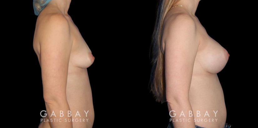 Silicone implants results for female patient in her 30s. Smaller, loose breasts were augmented to a firmer, taut volume with minimal overhang for improved comfort.