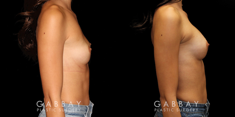 Patient before and after silicone breast augmentation. Patient’s slimmer body matched smaller implants to maintain a balance with her natural figure.