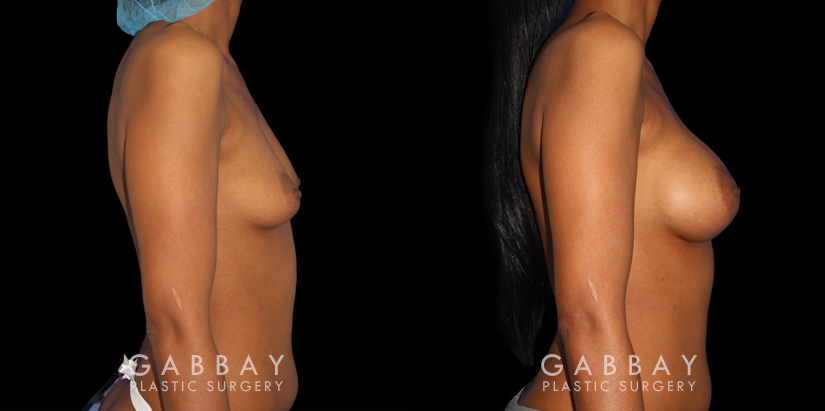 Silicone implants were used to increase breast volume while preserving the patient’s natural breast shape. The increased bust size resulted in a feminine, refined profile.