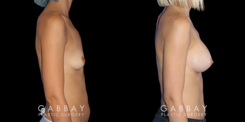 Using silicone implants, the patient saw increased breast volume while maintaining a comfortable, proportionate size. Nipple position and overall breast aesthetic was maintained while increasing size.