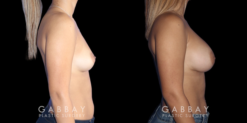 Visual of results following recovery for breast augmentation with saline implants. Patient shows dramatic increase in breast volume while keeping a more natural slope and shape to the breasts.