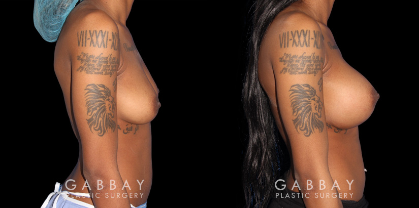 Patient with significant breast volume increase through breast augmentation with silicone implants. Profile view demonstrates the enhanced breast size by silhouette with an alluring, round shape.