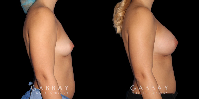 Silicone implants used to increase breast size in female patient in her 30s. Boost ot breast volume resulted in a more feminine contour from each before-and-after photo angle.