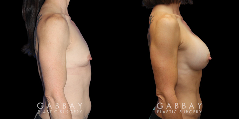 Breast augmentation results for patient with slim and fit body type. The silicone implants were chosen to match this tighter physique for a natural balance.