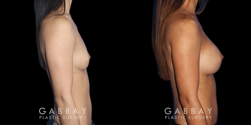 Before-and-after photos for breast augmentation showing fully recovered patient. Note the lack of visible scarring despite the dramatic increase to bust volume. Balanced, round breast shape enhances the patient’s natural figure.