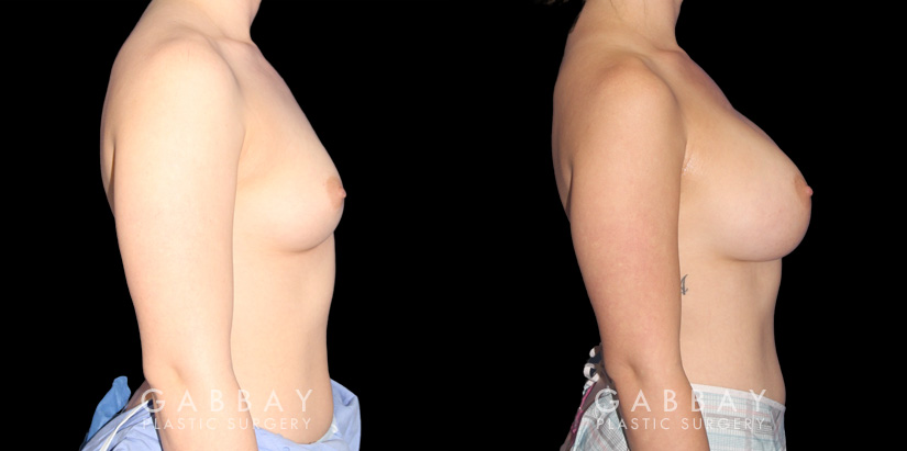 Smoother recovery for patient who chose silicone implants for breast augmentation. Breast position was maintained to keep a natural look that enhances her body type’s contours.