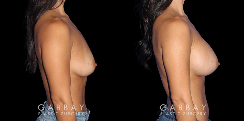 Female patient in her 30s before and after breast augmentation. Increased cup size was balanced with her natural body shape.